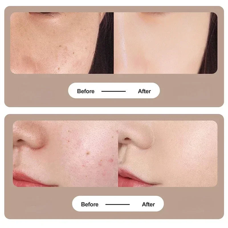 Zinc Alloy Microneedle Derma Roller – Manual Facial & Body Microneedling Tool for Wrinkle Removal & Skin Rejuvenation